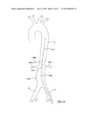 STENT-GRAFT PROSTHESIS FOR PLACEMENT IN THE ABDOMINAL AORTA diagram and image