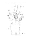 STENT-GRAFT PROSTHESIS FOR PLACEMENT IN THE ABDOMINAL AORTA diagram and image