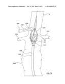 STENT-GRAFT PROSTHESIS FOR PLACEMENT IN THE ABDOMINAL AORTA diagram and image