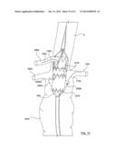 STENT-GRAFT PROSTHESIS FOR PLACEMENT IN THE ABDOMINAL AORTA diagram and image