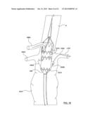 STENT-GRAFT PROSTHESIS FOR PLACEMENT IN THE ABDOMINAL AORTA diagram and image