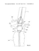 STENT-GRAFT PROSTHESIS FOR PLACEMENT IN THE ABDOMINAL AORTA diagram and image