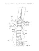 STENT-GRAFT PROSTHESIS FOR PLACEMENT IN THE ABDOMINAL AORTA diagram and image