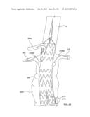 STENT-GRAFT PROSTHESIS FOR PLACEMENT IN THE ABDOMINAL AORTA diagram and image