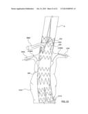 STENT-GRAFT PROSTHESIS FOR PLACEMENT IN THE ABDOMINAL AORTA diagram and image