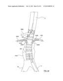 STENT-GRAFT PROSTHESIS FOR PLACEMENT IN THE ABDOMINAL AORTA diagram and image