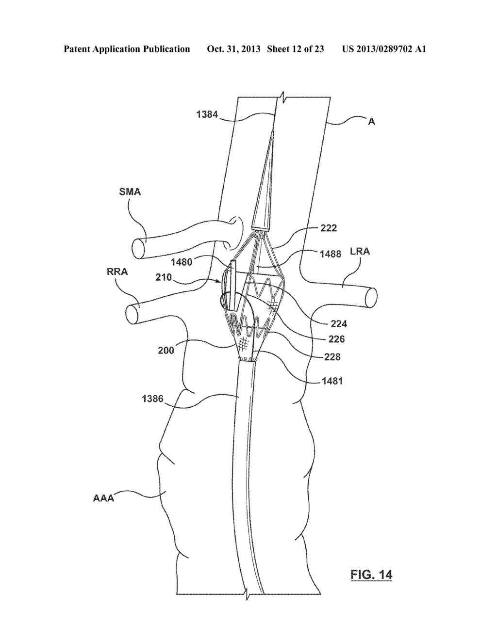 STENT-GRAFT PROSTHESIS FOR PLACEMENT IN THE ABDOMINAL AORTA - diagram, schematic, and image 13