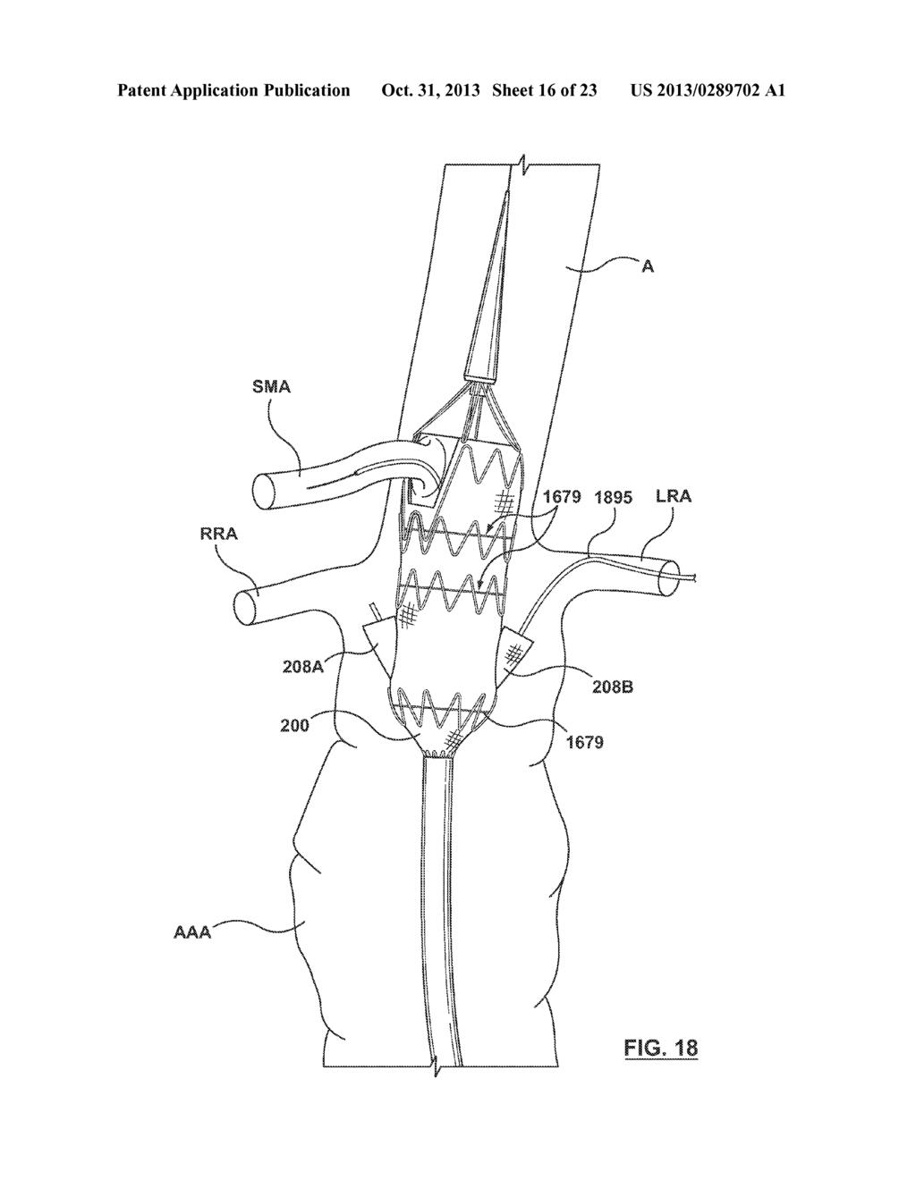 STENT-GRAFT PROSTHESIS FOR PLACEMENT IN THE ABDOMINAL AORTA - diagram, schematic, and image 17