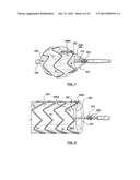 RING ON A CLOSED WEB STENT-GRAFT FOR USE IN TIP CAPTURE diagram and image