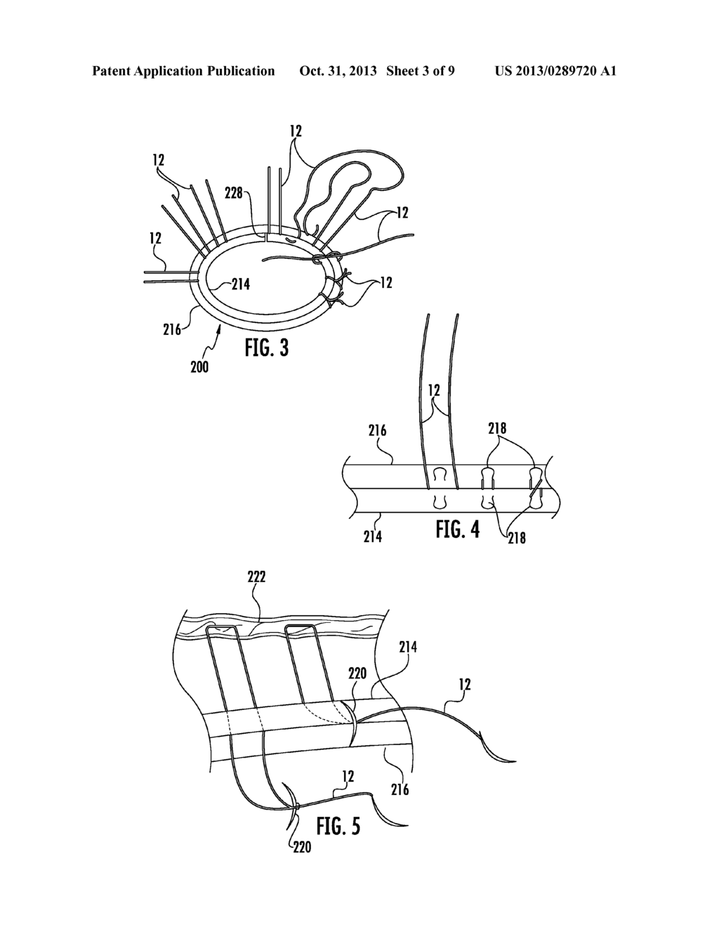 PROSTHETIC DEVICE FOR HEART VALVE REINFORCEMENT AND REMODELING PROCEDURES - diagram, schematic, and image 04