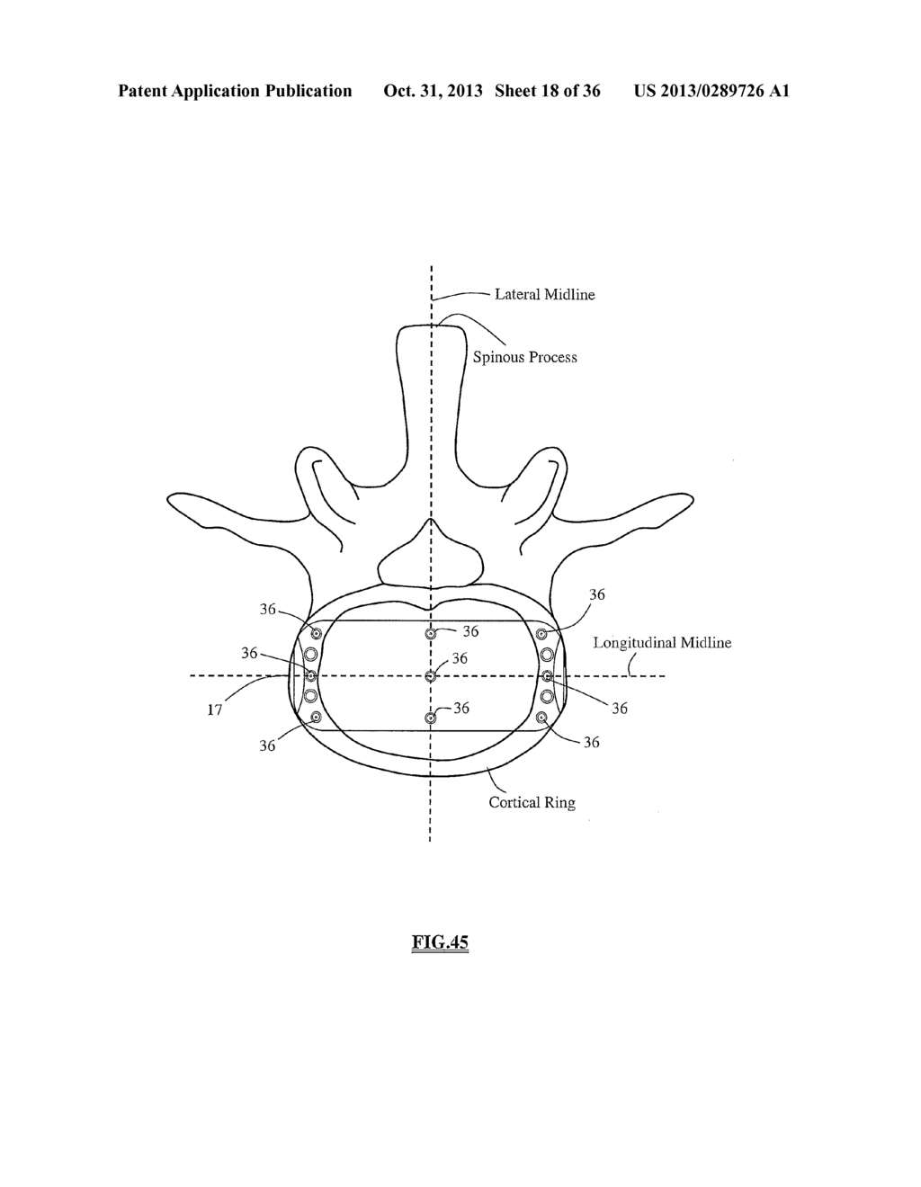 Total Disc Replacement System and Related Methods - diagram, schematic, and image 19