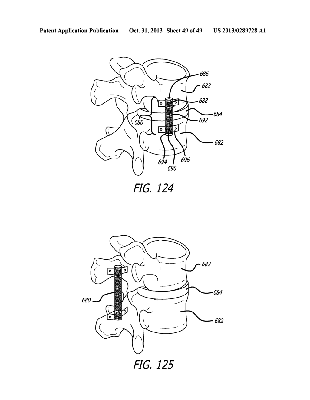 EXTRA-ARTICULAR IMPLANTABLE MECHANICAL ENERGY ABSORBING SYSTEMS - diagram, schematic, and image 50