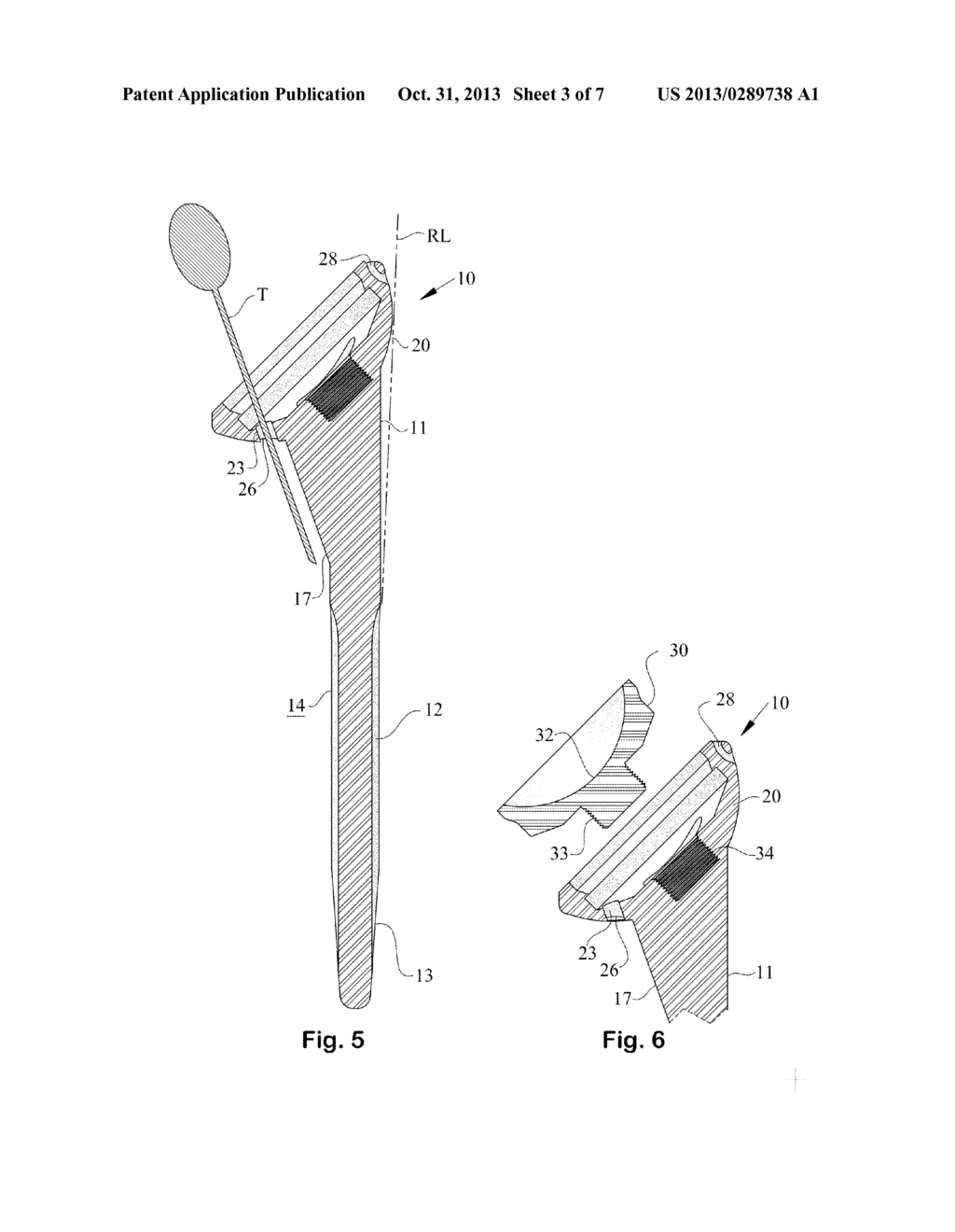 Prosthesis Having a Metaphyseal Element and Methods for Achieving a     Press-Fit and Removal of the Prosthesis - diagram, schematic, and image 04