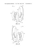 SPACER MOLDS FOR ORTHOPEDIC IMPLANTS diagram and image