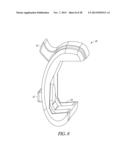 SPACER MOLDS FOR ORTHOPEDIC IMPLANTS diagram and image