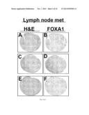 FOXA1 AS A MARKER FOR INVASIVE BLADDER CANCER diagram and image