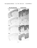 FOXA1 AS A MARKER FOR INVASIVE BLADDER CANCER diagram and image