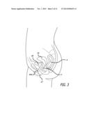 System for Delivering Anchors for Treating Incontinence diagram and image