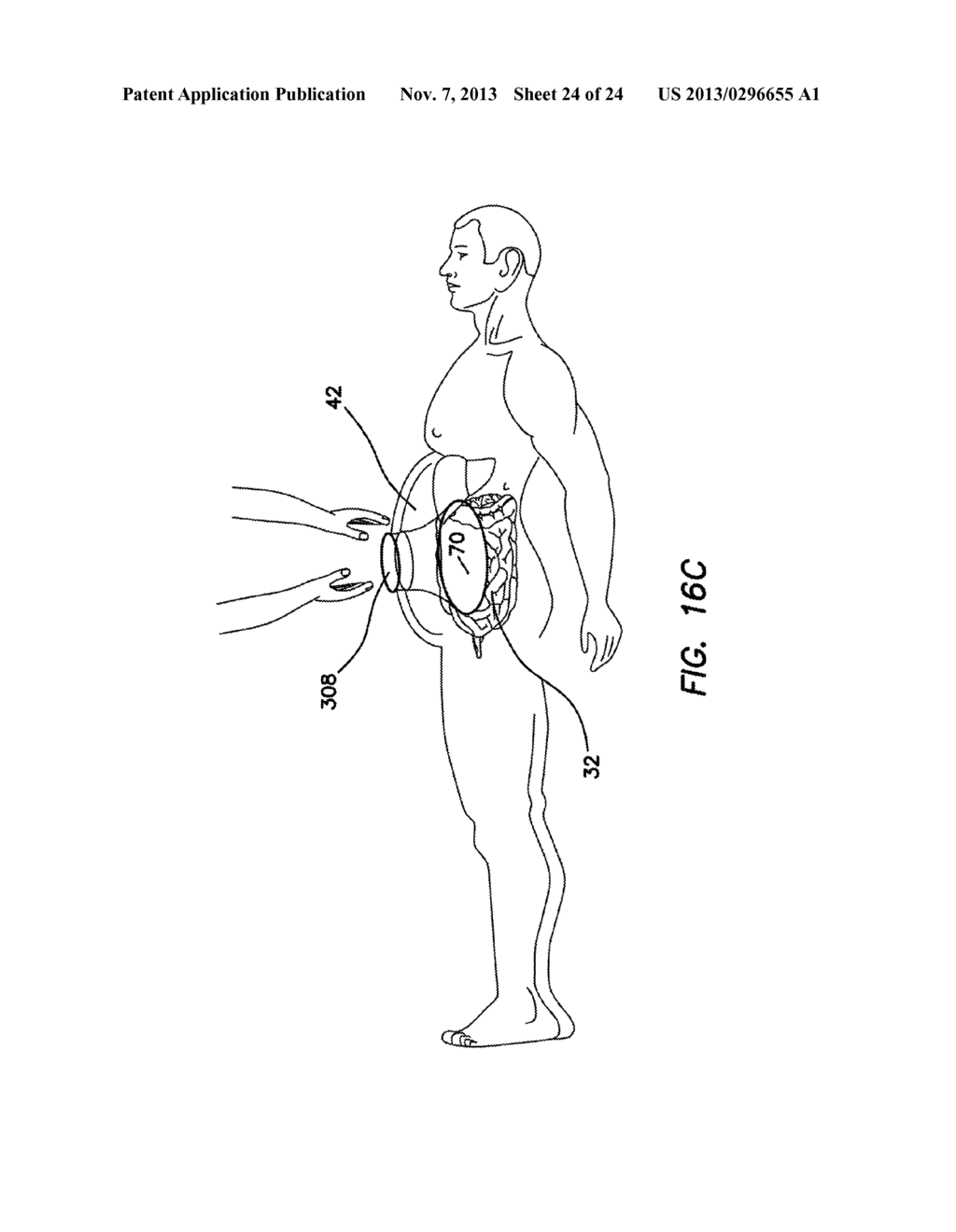 SURGICAL ACCESS DEVICE COMPRISING INTERNAL RETRACTOR - diagram, schematic, and image 25