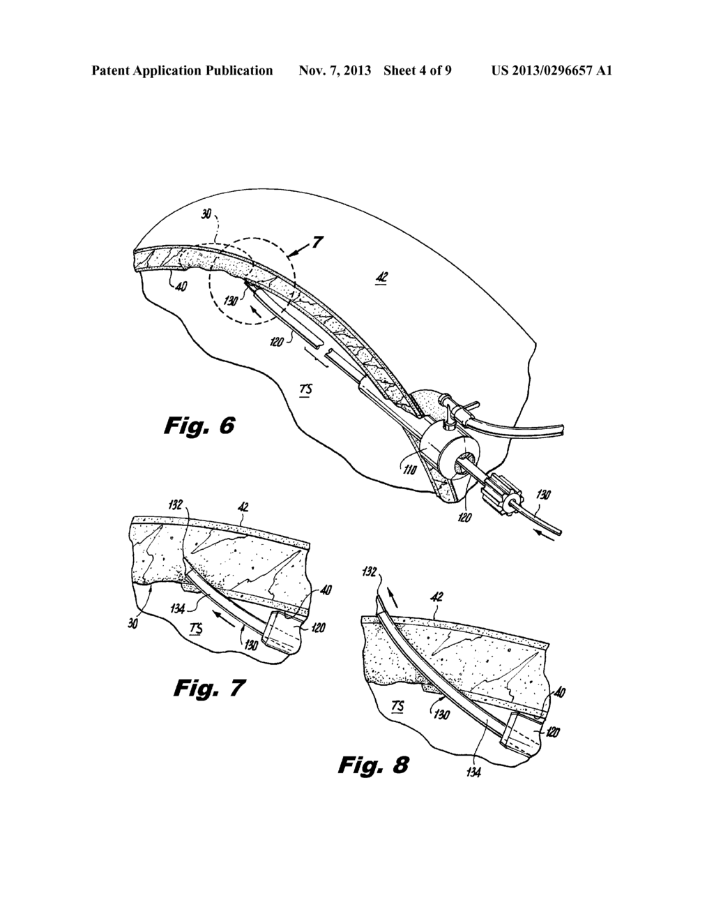 METHODS OF USING LIGHT TO REPAIR HERNIA DEFECTS - diagram, schematic, and image 05