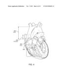 RIGHT ATRIUM INDICATOR diagram and image