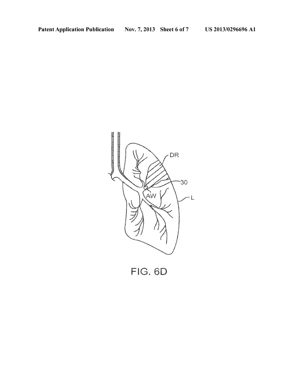 METHODS AND DEVICES FOR PASSIVE RESIDUAL LUNG VOLUME REDUCTION AND     FUNCTIONAL LUNG VOLUME EXPANSION - diagram, schematic, and image 07