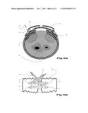 ORTHOSIS FOR MOVEMENT DAMPING diagram and image