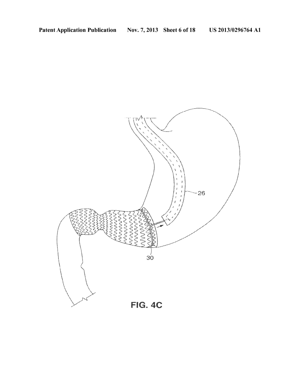 SATIATION DEVICES AND METHODS - diagram, schematic, and image 07