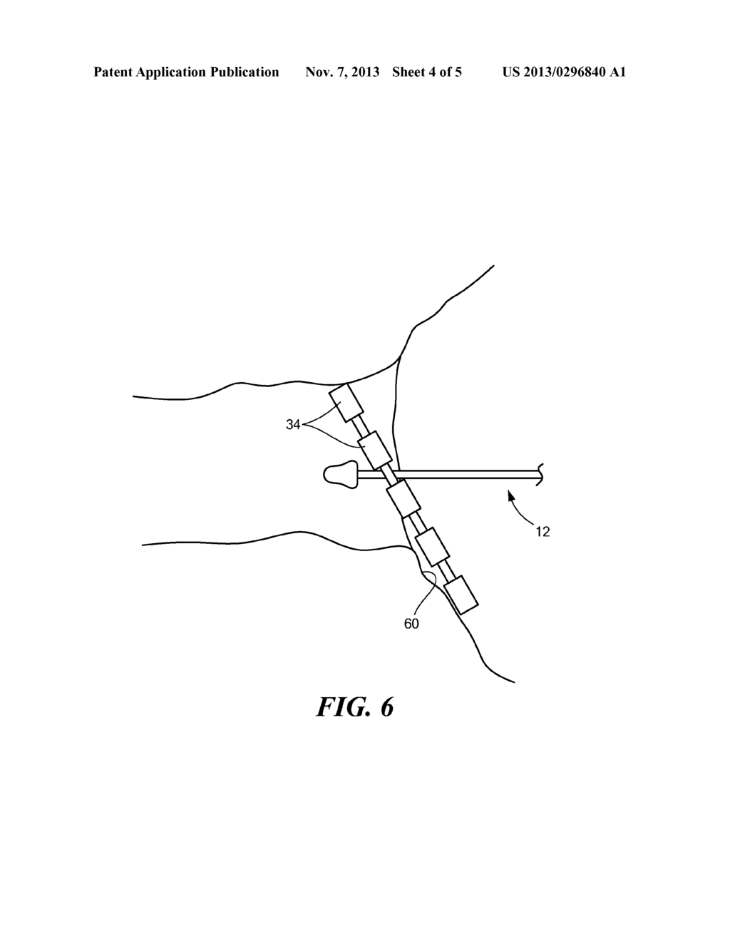 SYSTEMS AND METHODS FOR DETECTING TISSUE CONTACT DURING ABLATION - diagram, schematic, and image 05