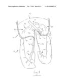 ABLATION CATHETER HAVING TEMPERATURE-CONTROLLED ANCHOR AND RELATED METHODS diagram and image