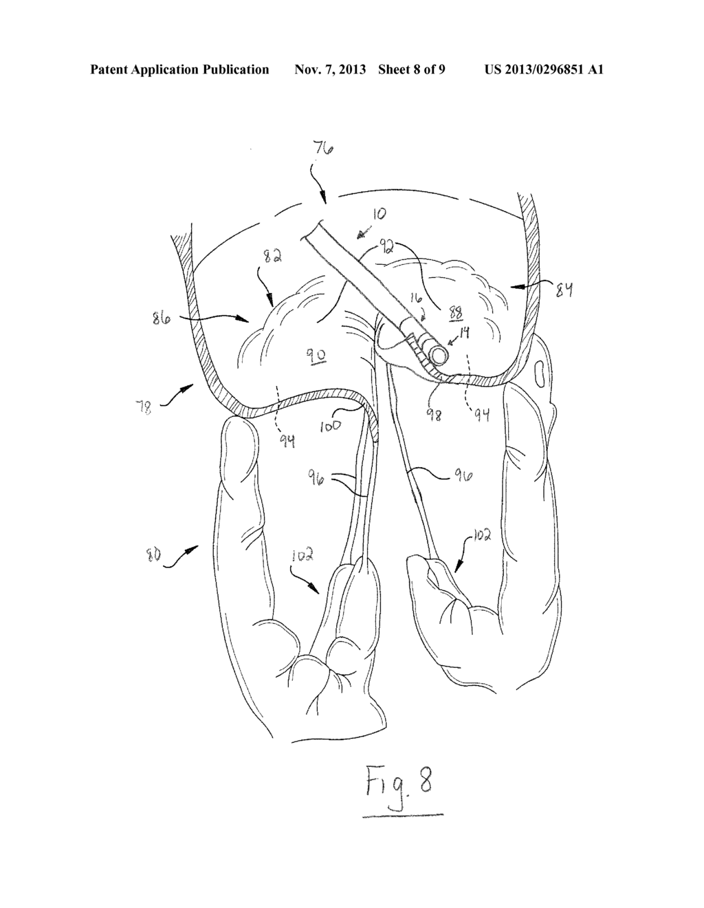 ABLATION CATHETER HAVING TEMPERATURE-CONTROLLED ANCHOR AND RELATED METHODS - diagram, schematic, and image 09