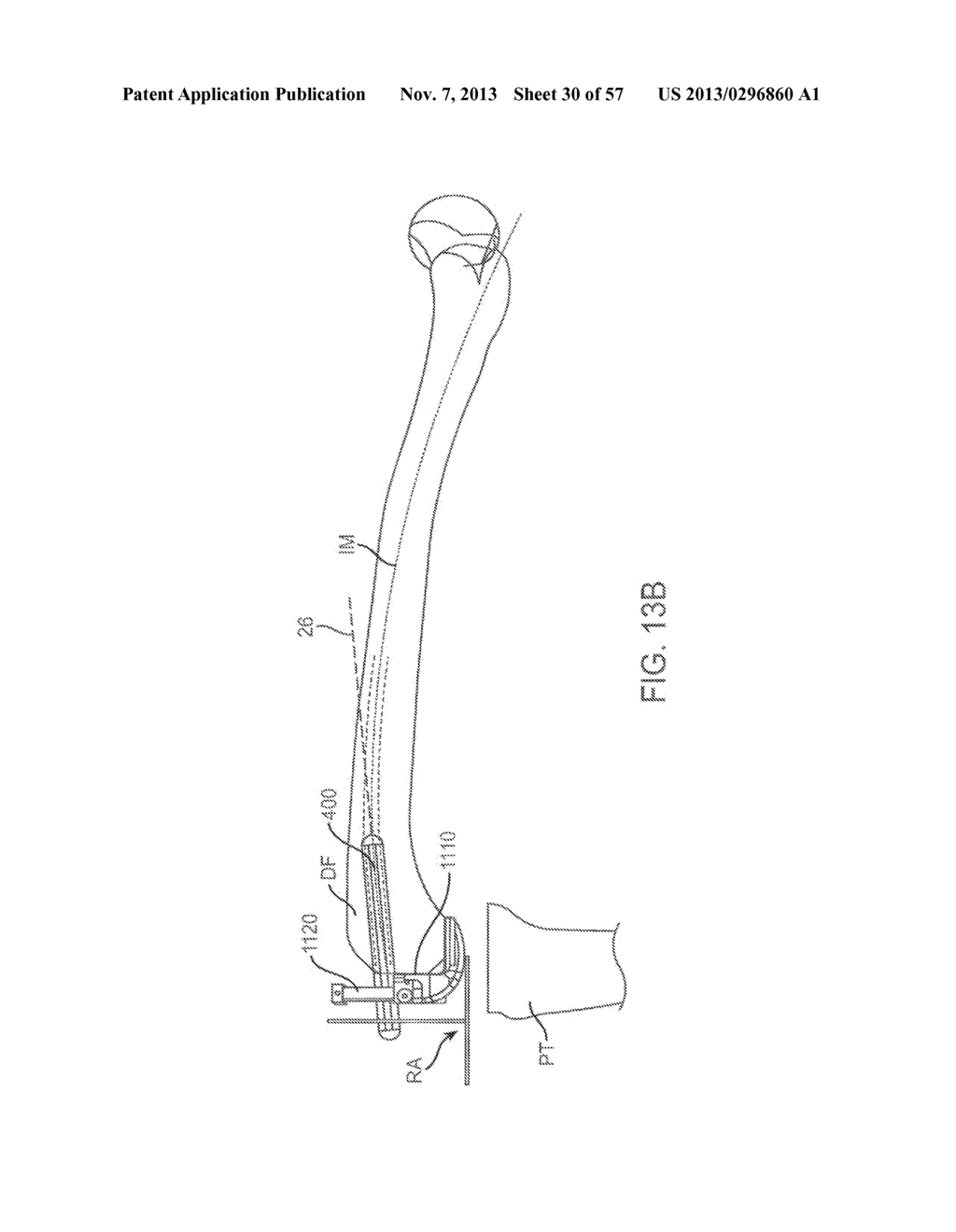 KNEE BALANCING FOR REVISION PROCEDURES - diagram, schematic, and image 31