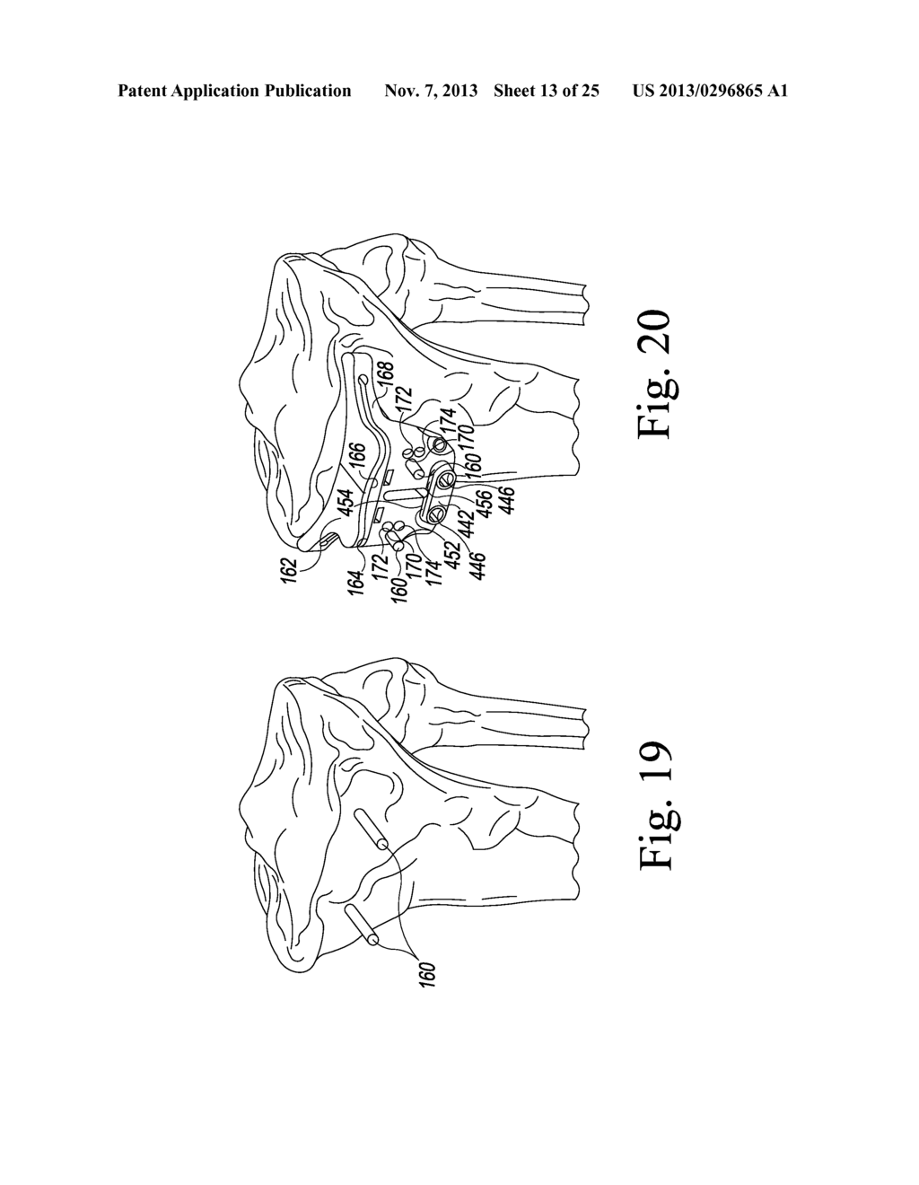 CUSTOMIZED PATIENT-SPECIFIC ORTHOPAEDIC PIN GUIDES - diagram, schematic, and image 14