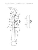 Surgical Guide with Cut Resistant Inserts diagram and image