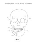 Surgical Guide with Cut Resistant Inserts diagram and image