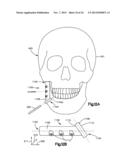 Surgical Guide with Cut Resistant Inserts diagram and image