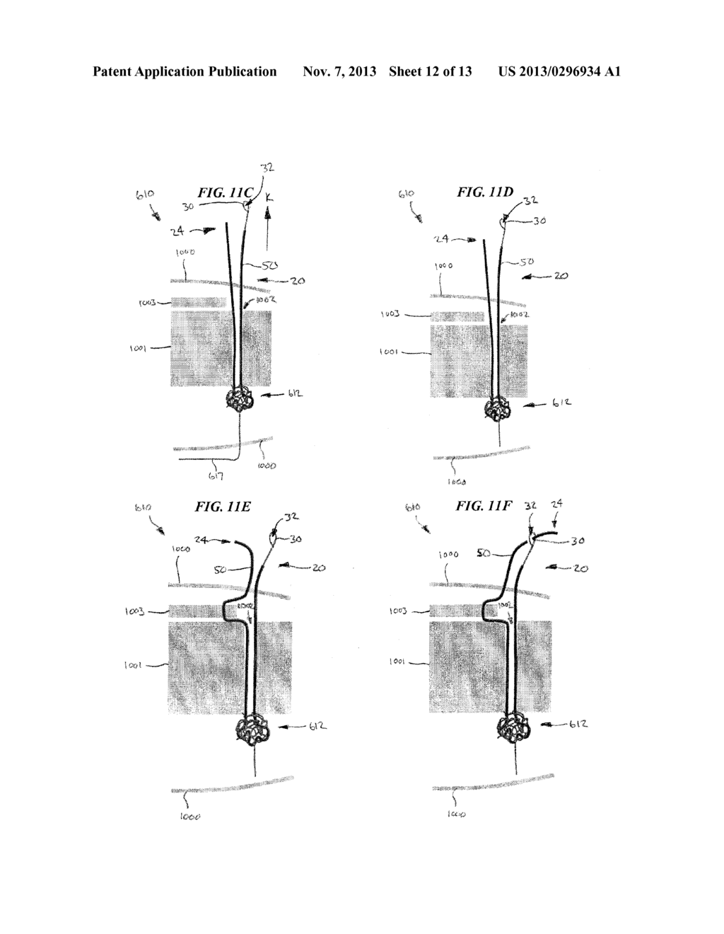 SYSTEMS, DEVICES, AND METHODS FOR SECURING TISSUEUSING SNARE ASSEMBLIES     AND SOFT ANCHORS - diagram, schematic, and image 13