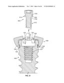 Bone Plate System diagram and image