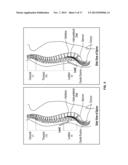 SYSTEMS AND METHODS RELATED TO THE TREATMENT OF BACK PAIN diagram and image