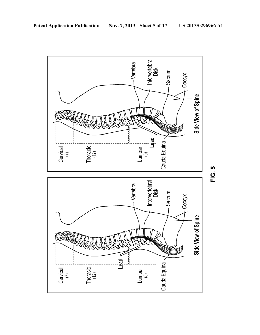 SYSTEMS AND METHODS RELATED TO THE TREATMENT OF BACK PAIN - diagram, schematic, and image 06