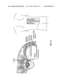 SYSTEMS AND METHODS RELATED TO THE TREATMENT OF BACK PAIN diagram and image