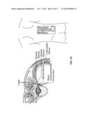 SYSTEMS AND METHODS RELATED TO THE TREATMENT OF BACK PAIN diagram and image