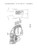 SYSTEMS AND METHODS RELATED TO THE TREATMENT OF BACK PAIN diagram and image