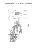 SYSTEMS AND METHODS RELATED TO THE TREATMENT OF BACK PAIN diagram and image