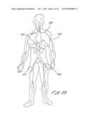 INDWELLING HEAT EXCHANGE CATHETER AND METHOD OF USING SAME diagram and image