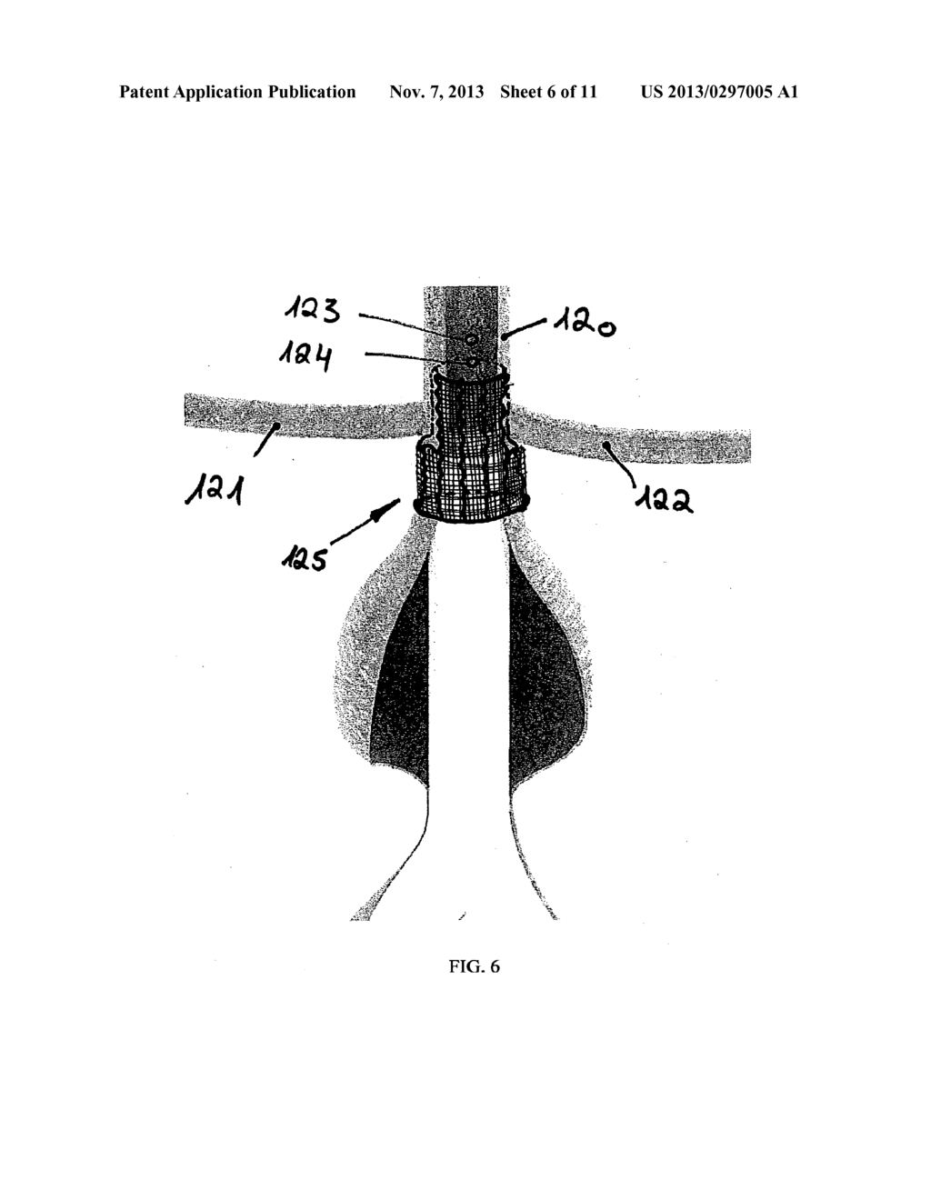 EXTRA-VASCULAR WRAPPING FOR TREATING ENDOLEAK - diagram, schematic, and image 07