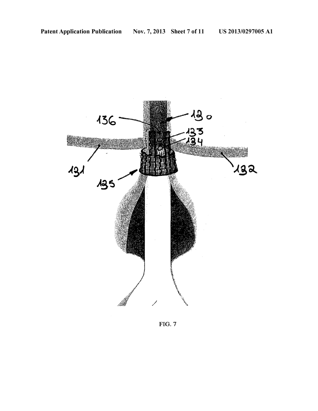 EXTRA-VASCULAR WRAPPING FOR TREATING ENDOLEAK - diagram, schematic, and image 08