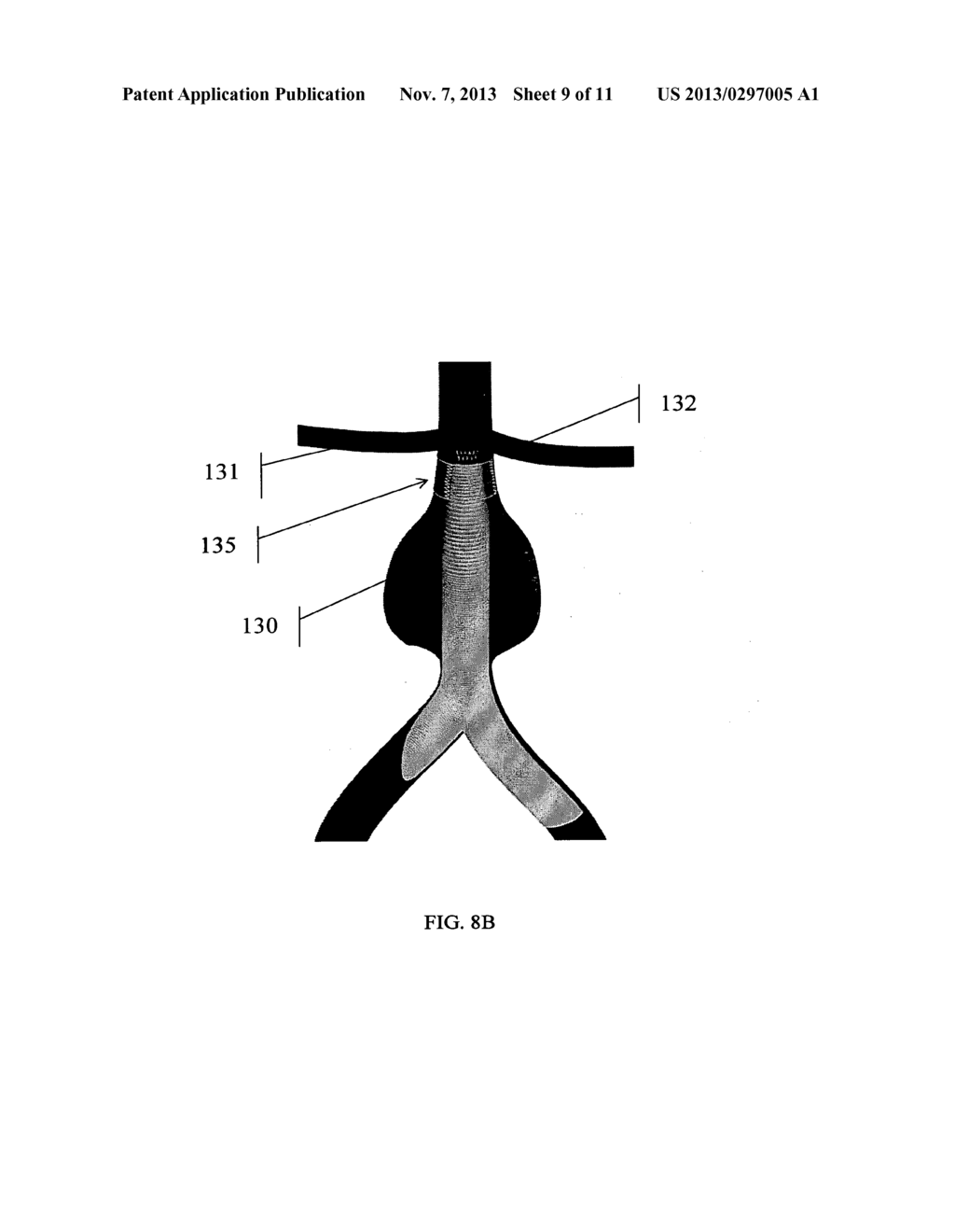 EXTRA-VASCULAR WRAPPING FOR TREATING ENDOLEAK - diagram, schematic, and image 10