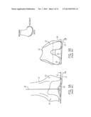 PROSTHESIS AND METHOD FOR USING PROSTHESIS TO FACILITATE DEEP KNEE FLEXION diagram and image