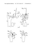 PARTIAL OR COMPLETE PROSTHETIC REPLACEMENT ARTHROPLASTY OF THE DISTAL     RADIOULNAR JOINT diagram and image